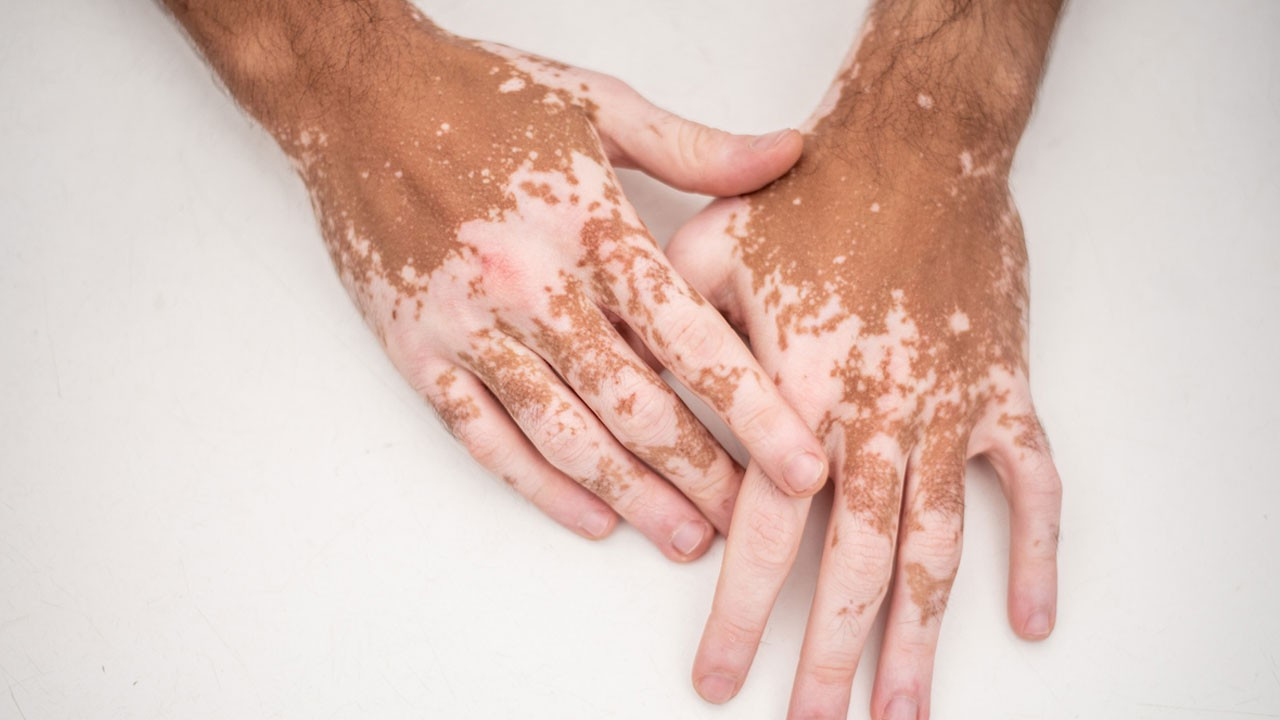 Vitiligo hastalığı nedir, neden olur? Vitiligo tedavisi nasıl yapılır? 5 soruda vitiligo