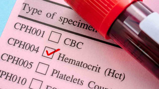 HCT (hematokrit) nedir? HCT değer aralıkları ne olmalı? HCT düşüklüğü ve yüksekliği nedenleri