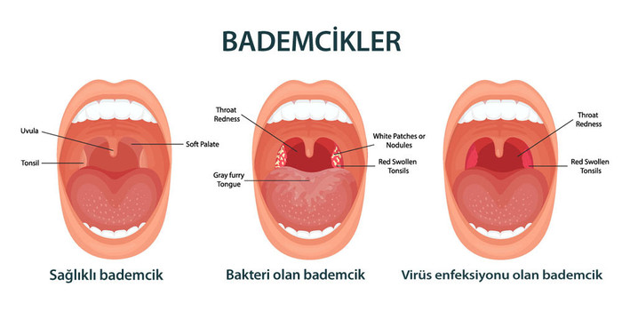 Bademcik iltihabı bulaşıcı mıdır? Tedavisi nasıl olur? - Resim : 1