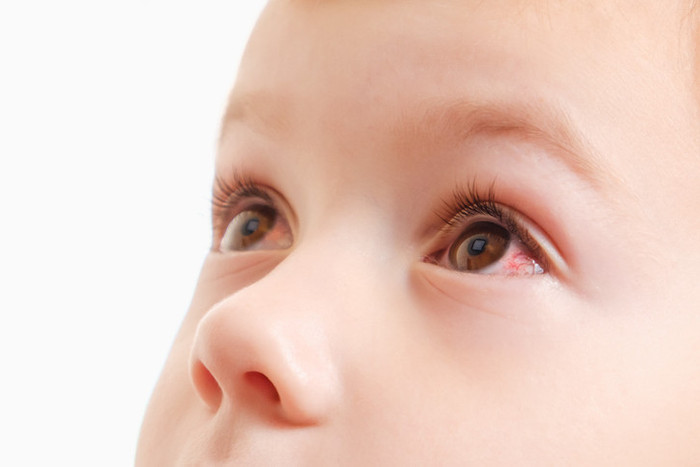 Bebek ve çocuklarda göz nezlesi neden olur? Bulaşıcı mıdır? - Resim : 2