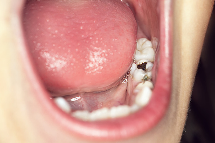 Süt dişleri neden çürür? Nasıl önlem almalı? - Resim : 1