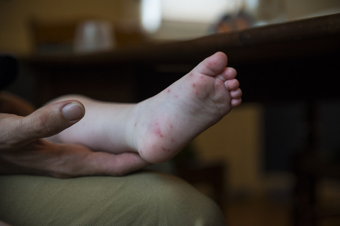 El ayak ağız hastalığı nedir, neden olur? El ayak ağız hastalığı belirtileri neler? 7 soruda el ayak ağız hastalığı - Resim : 1