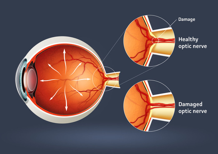 Optik nevrit nedir, neden olur? Tedavisi nasıl yapılır? İşte belirtileri - Resim : 1