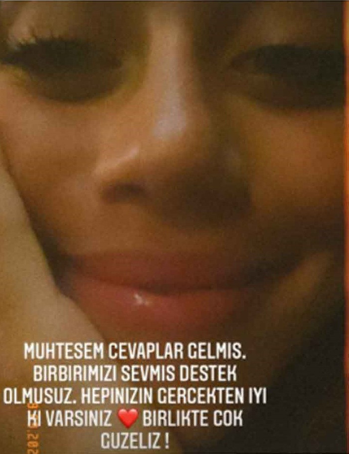 Zeynep Alkan 'kusursuz güzellik' algısına tepkili: Yüzündeki sivilceleri paylaştı - Resim : 1