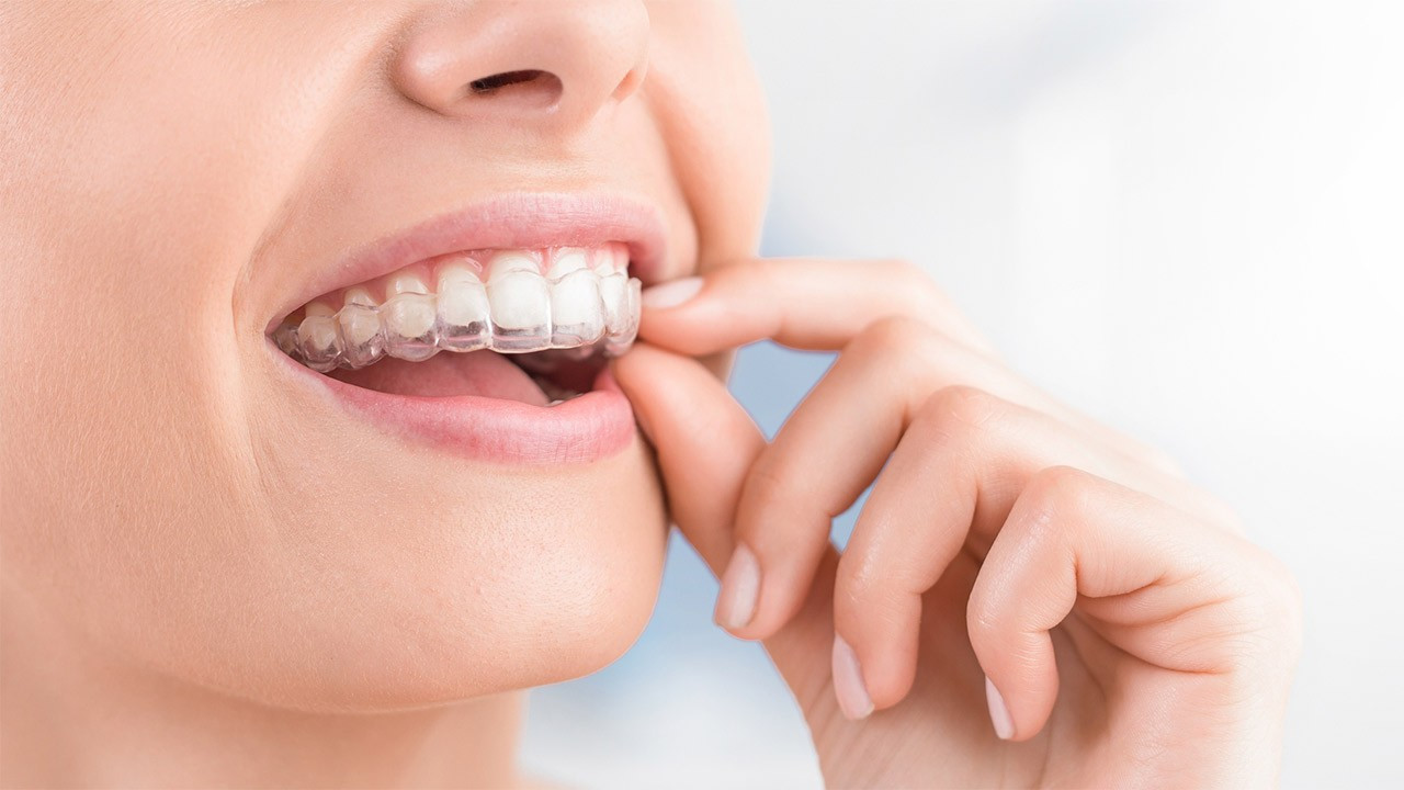 Diş teli ve şeffaf plak tedavisi arasındaki farklar nelerdir?