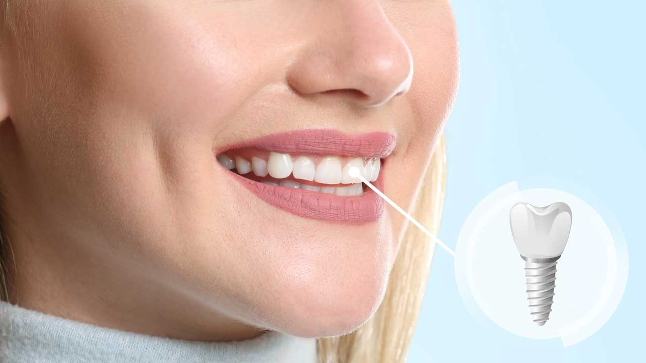 Diş implantı nedir? İmplant tedavisinin avantajları nelerdir?