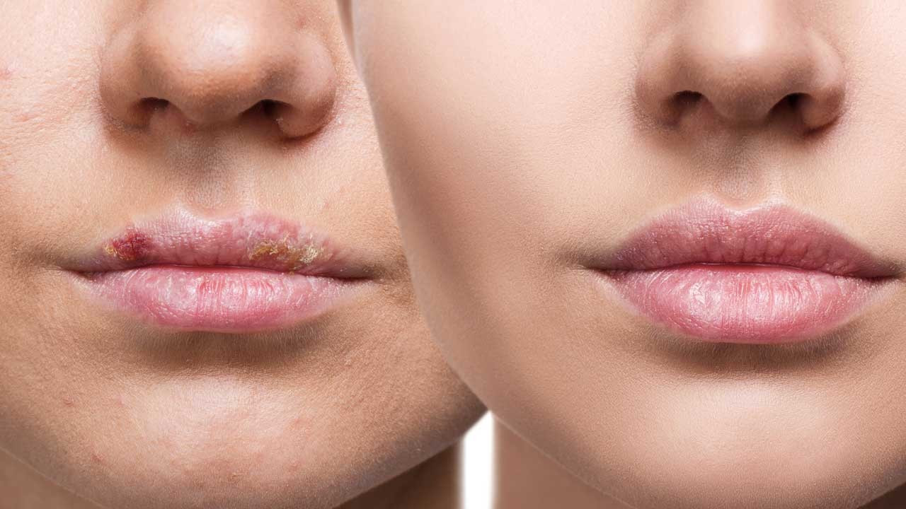 Kuru ve çatlak dudakları iyileştirmenin 7 yolu