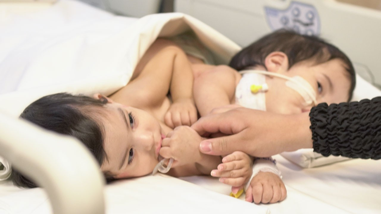 Cezayir’de yapışık ikiz olarak doğan bebekler ameliyatla ayrıldı