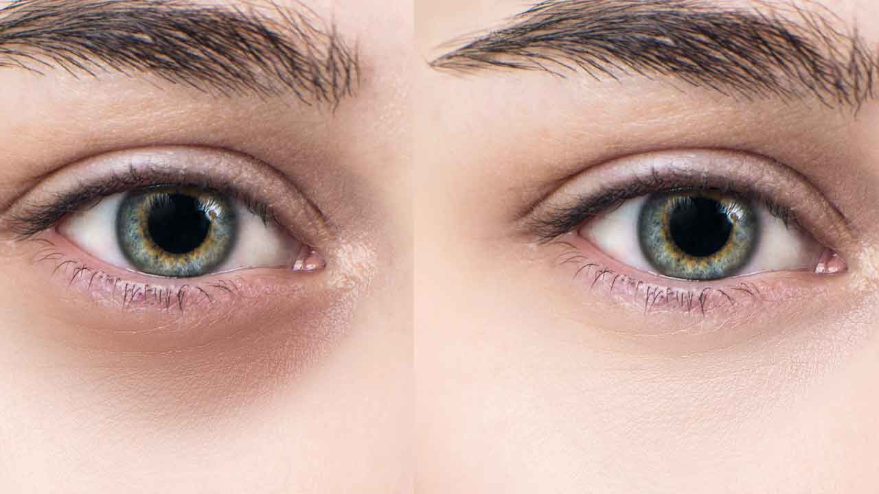 Göz altı morluklarının nedenleri ne? Nasıl geçer? 2 doğal çözüm