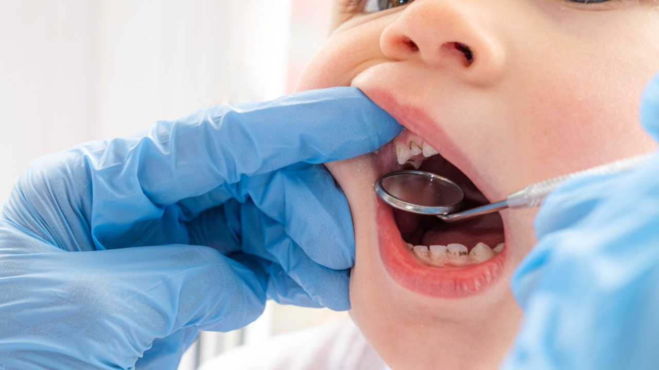 Süt dişleri neden çürür? Nasıl önlem almalı?