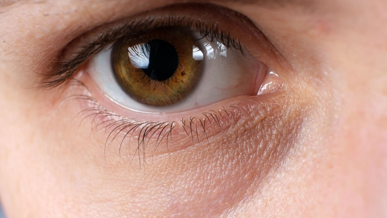 Göz altı halkalarının en yaygın 7 nedeni