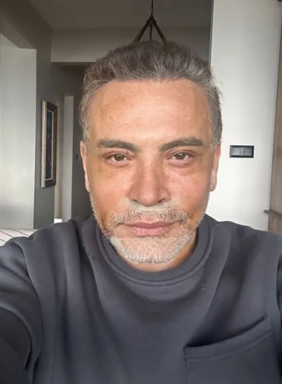 Estetikli ünlüler kervanına Cenk Eren de katıldı! Son halini görenler tanıyamadı