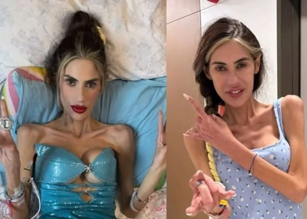 İrem Derici, Anoreksiya Nervoza'yla mücadele verdiği dönemden fotoğrafını paylaştı: Belki hala yenemedim